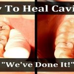 How to Heal Cavities (A True "We've Done It" Story)